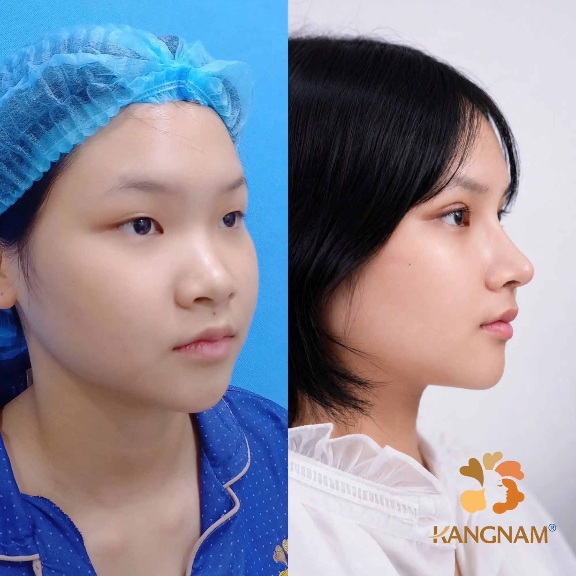 So sánh trước – sau cho thấy sự thay đổi của sống mũi và đầu mũi sau khi thực hiện phương pháp nâng mũi phù hợp.