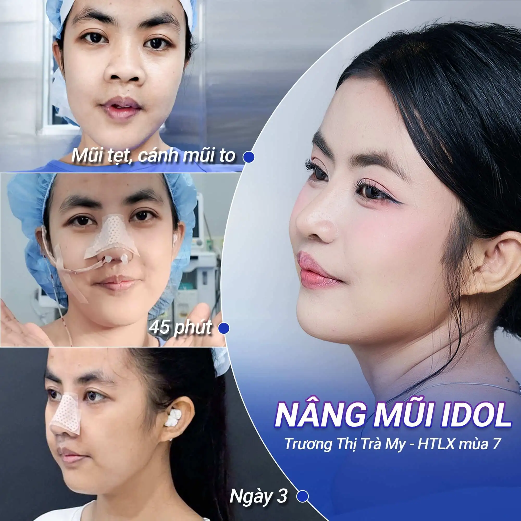 Dáng mũi tiếp tục thay đổi trong quá trình giảm sưng và ổn định mô sau phẫu thuật, vì vậy cần theo dõi theo hướng dẫn của bác sĩ.