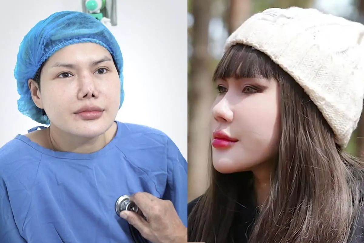 Quỳnh Mai gặp tình trạng mũi hỏng đã sửa 5 lần. Được các bác sĩ Kangnam phẫu thuật và chỉnh sửa