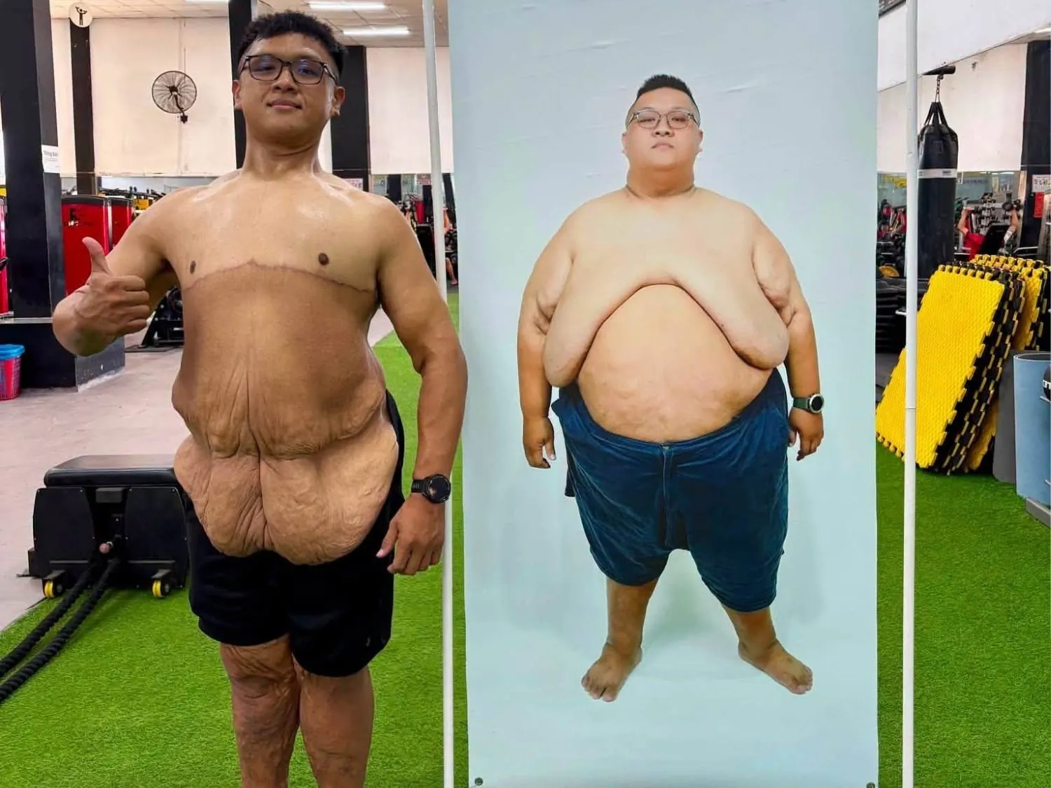 Cơ thể Trọng Nhân gọn hơn sau 2 lần loại bỏ da thừa