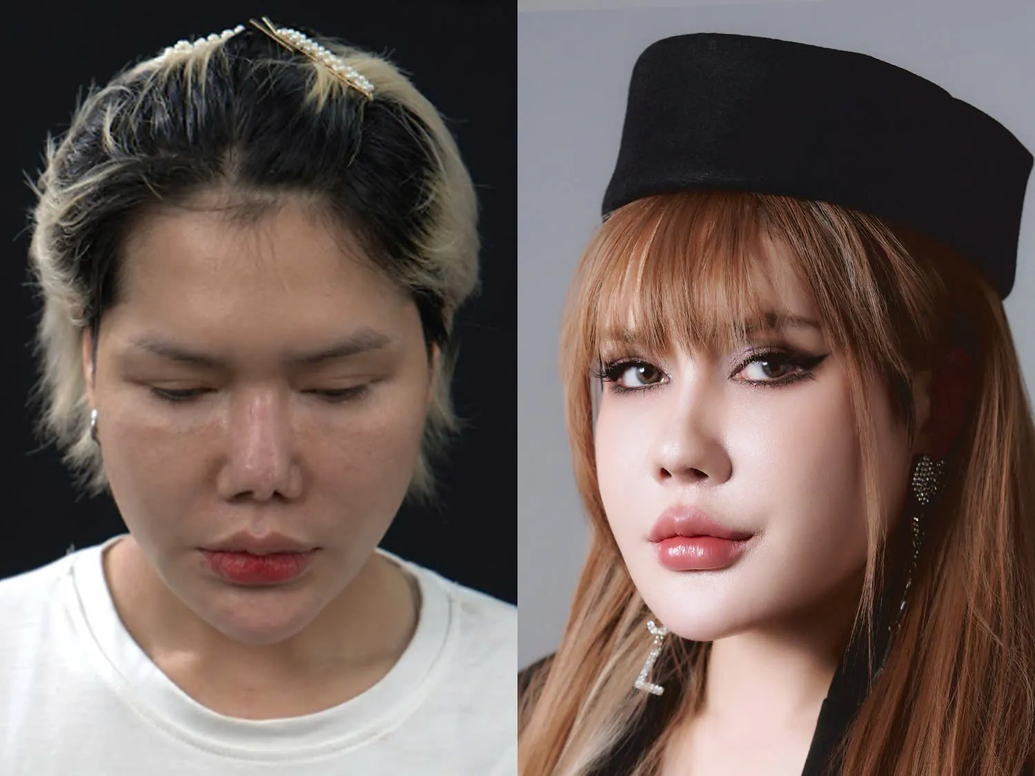Quỳnh Mai sở hữu dáng mũi cao cân đối, khắc phục tình trạng mũi hỏng 5 lần